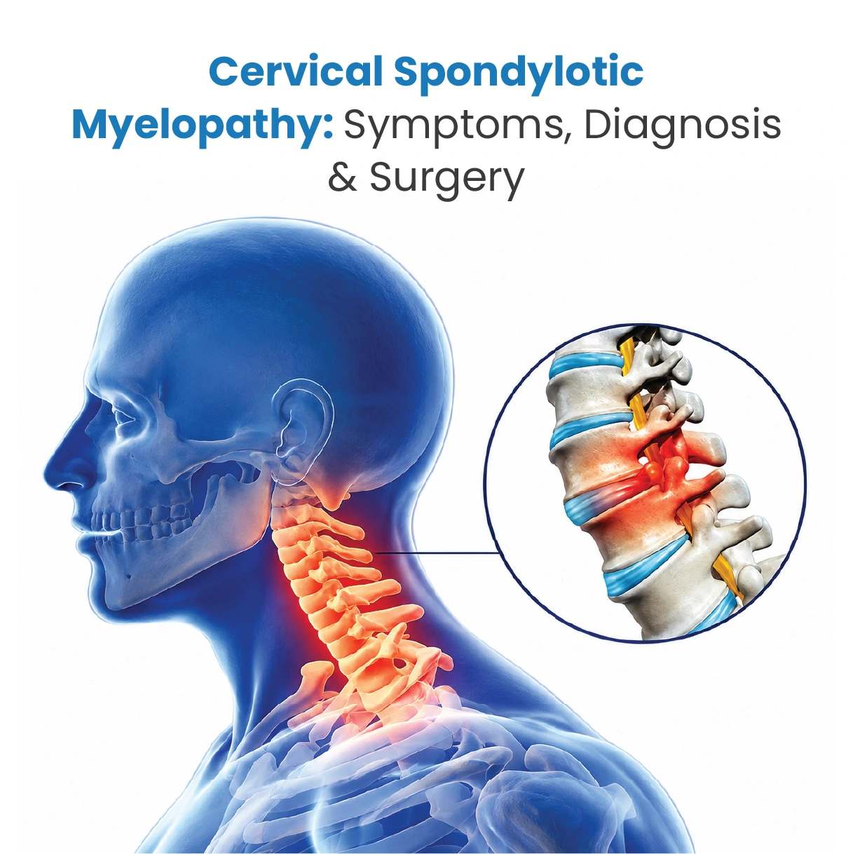 Cervical Spondylotic Myelopathy: Symptoms, Diagnosis & Surgery 